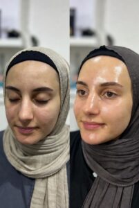 حجامه طبية فى المدينة المنوره